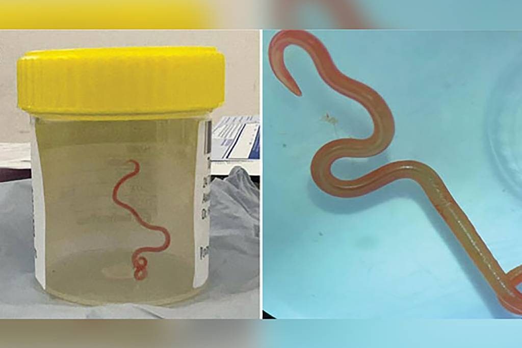 python parasite from woman's brain inside jar
